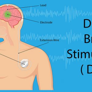 Ποιος ασθενής είναι υποψήφιος για νευροδιεγέρτη DBS